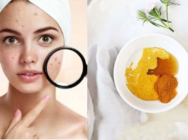 Top 10 Acne Home Remedies