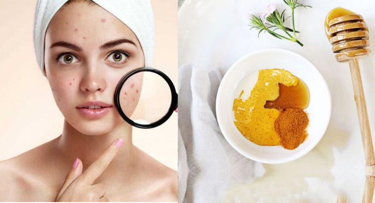 Top 10 Acne Home Remedies